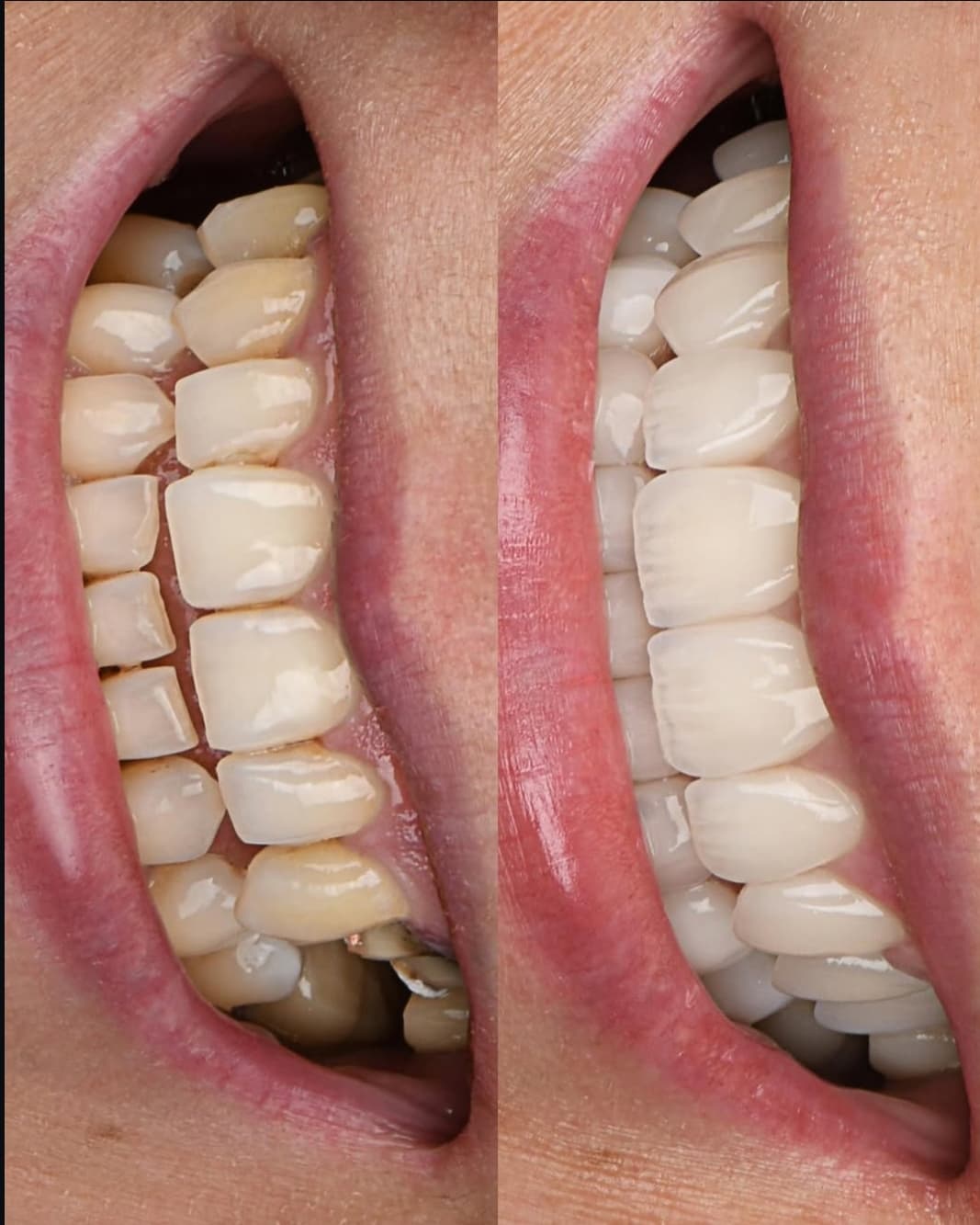 Before and After Dental Treatment